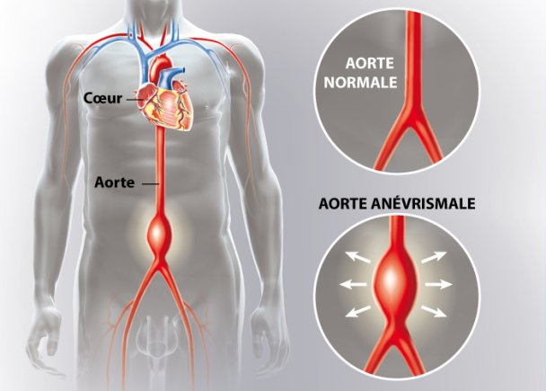 op-ration-an-vrisme-abdominal-an-vrisme-de-l-aorte-abdominale-baaqz